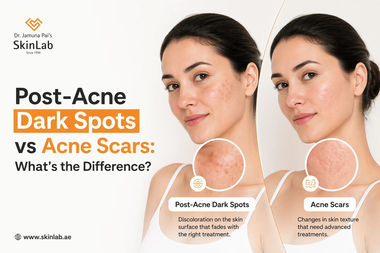 Post-Acne Dark Spots vs Acne Scars: What’s the Difference?