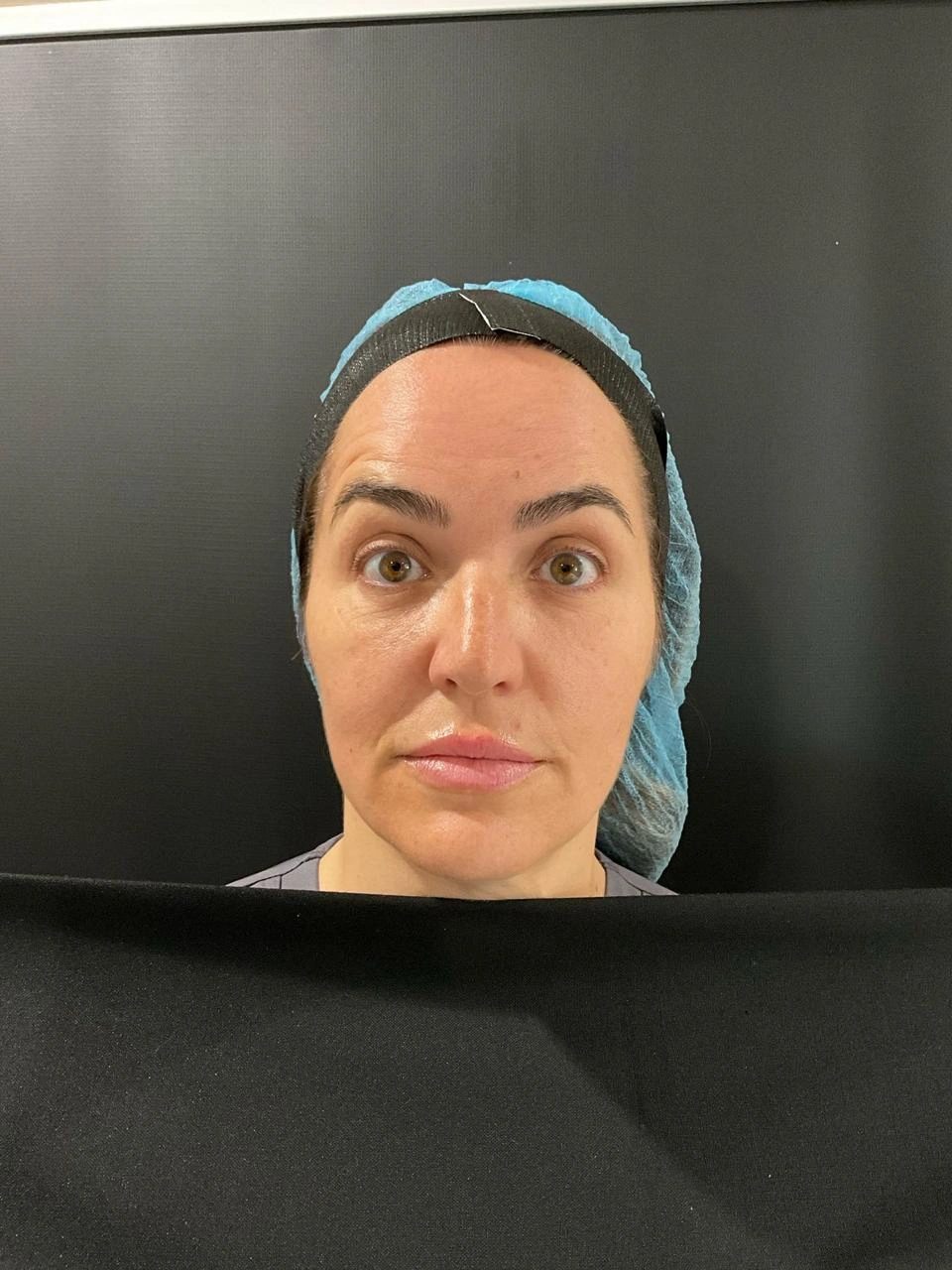 After Botox