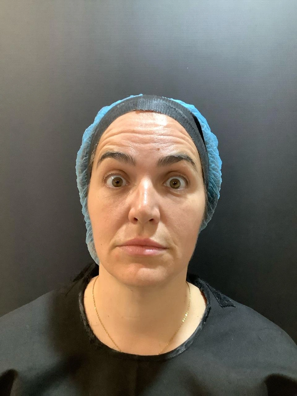 Before Botox