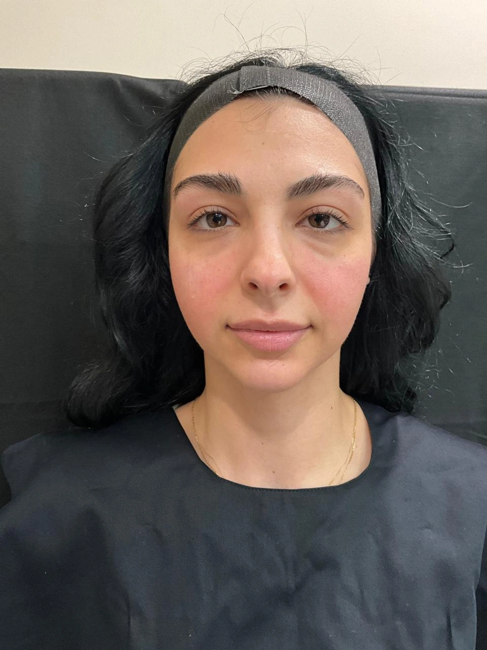 After Botox