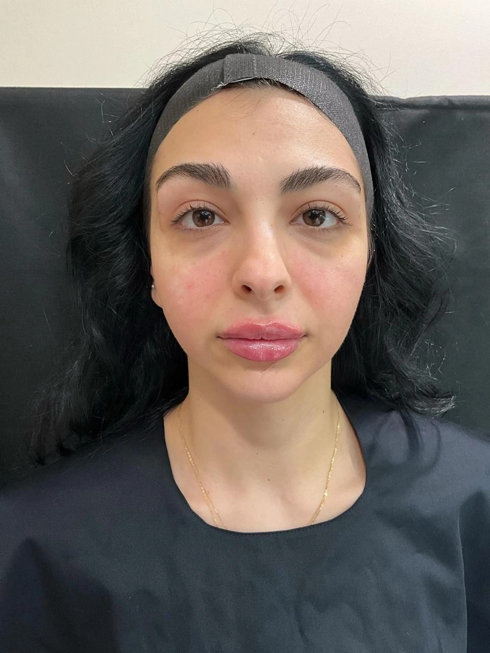 Before Botox
