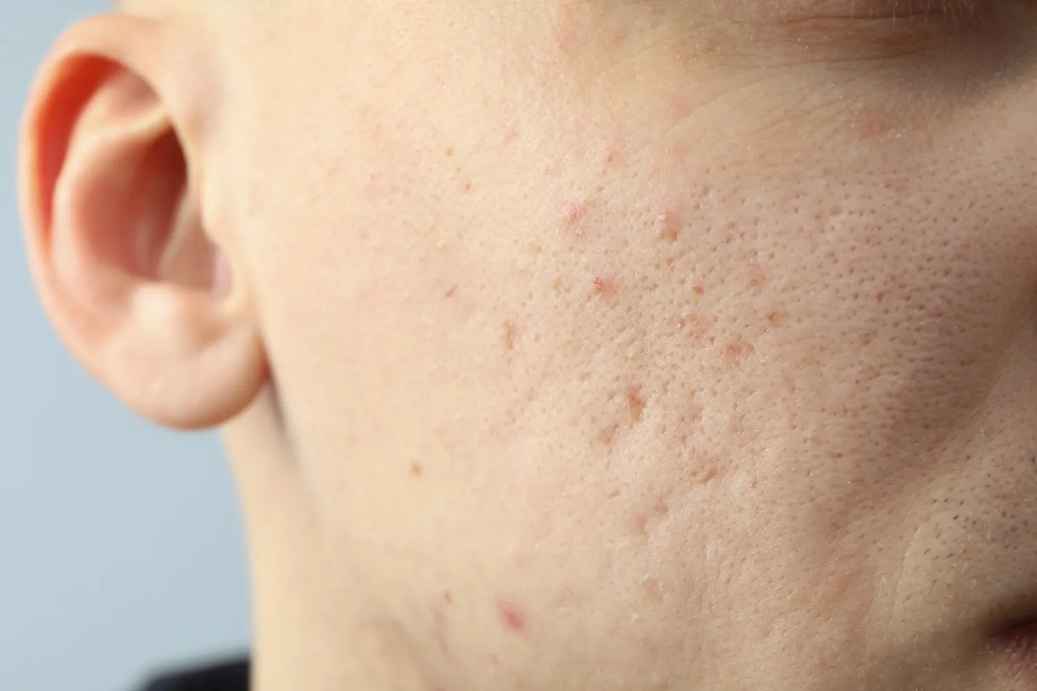 Hydrofacial treatment