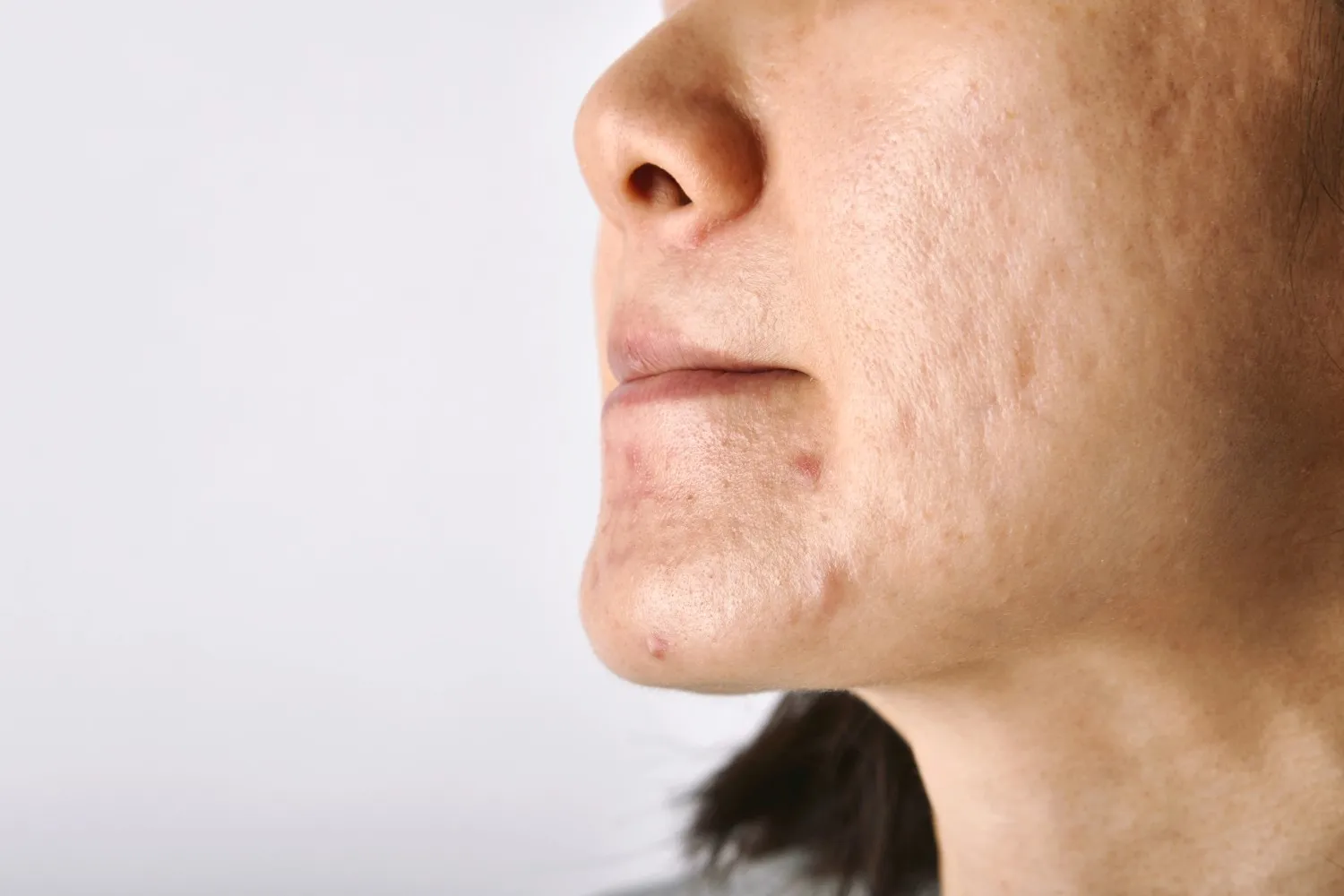 Hydrofacial treatment