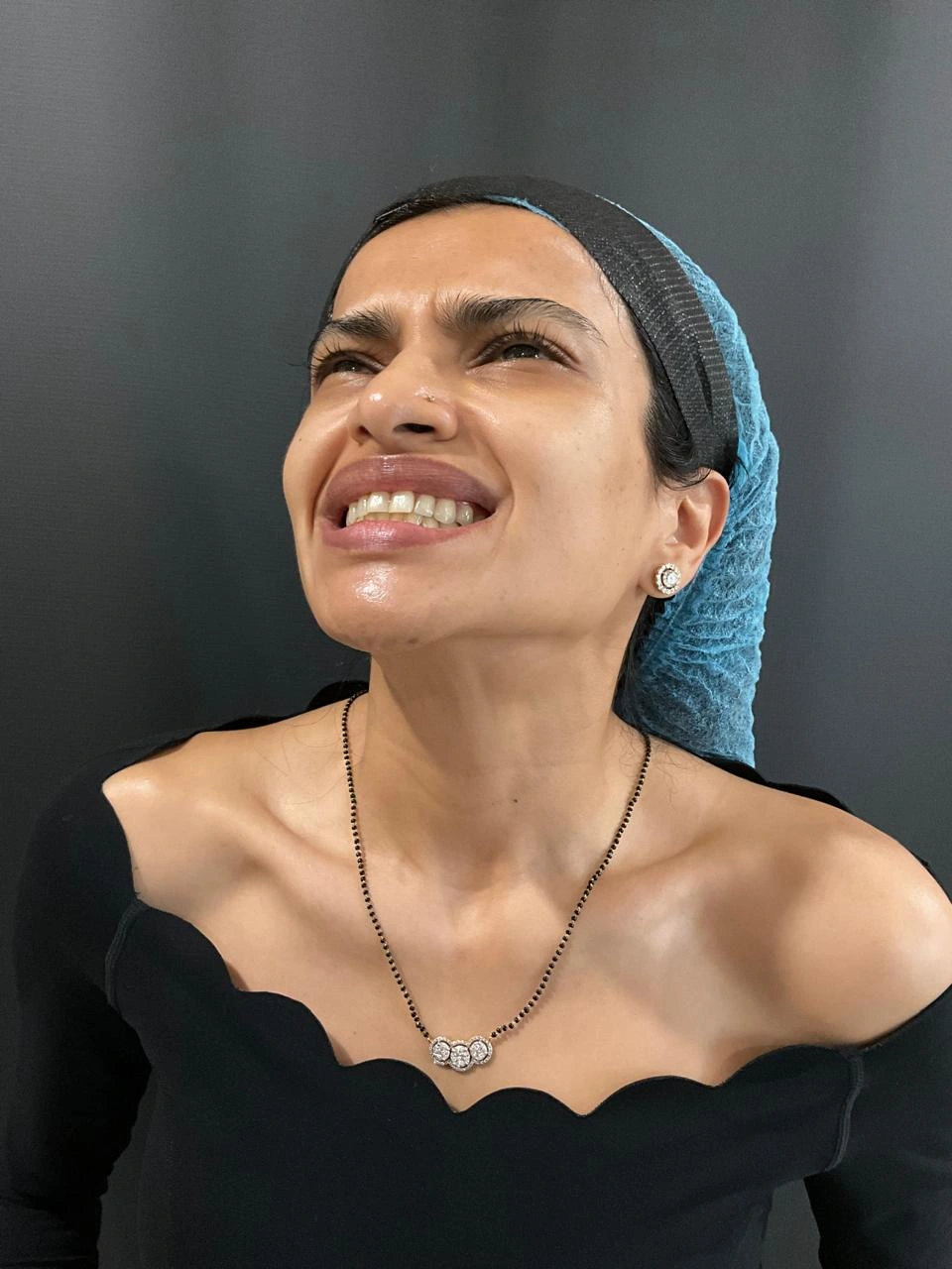 After Botox