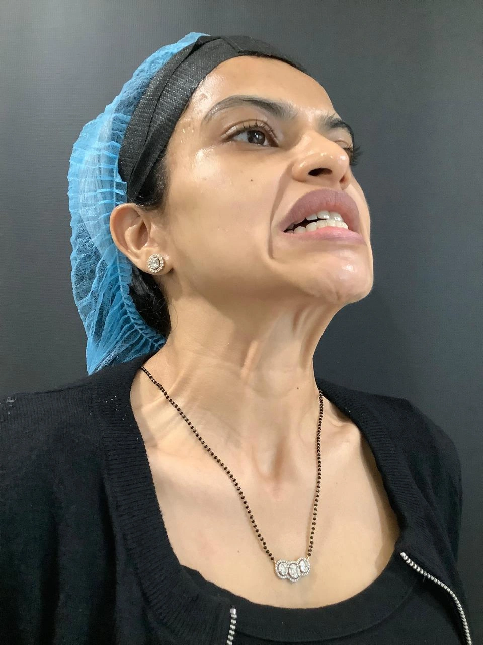 Before Botox